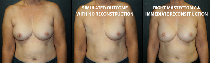 Breast Reconstruction: Case 8