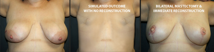 Breast Reconstruction Case 9