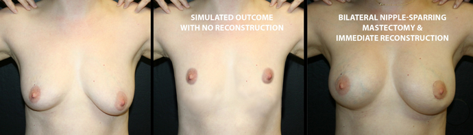 Breast Reconstruction: Case 10