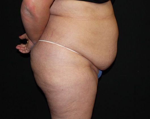 Abdominoplasty: Case 17 Abdominoplasty - Before