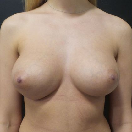 Breast Augmentation Case 3 - After
