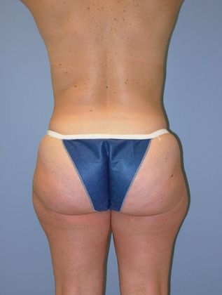 Abdominoplasty: Case 5 Abdominplasty - Before