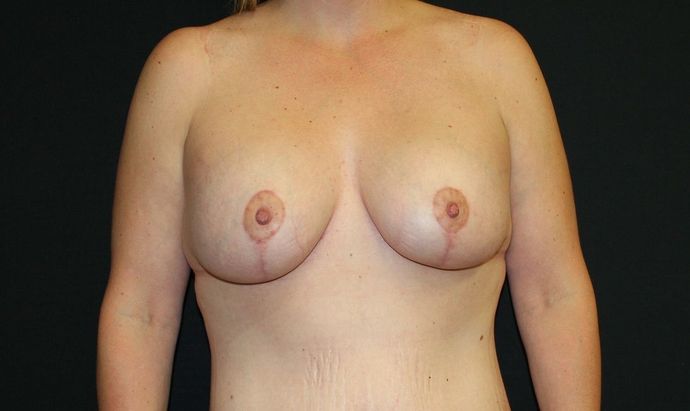 Breast Lift with Implant Case 7 Breast Lift with Implant - After