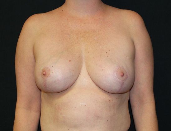 Breast Lift Case 18 Breast Lift - After