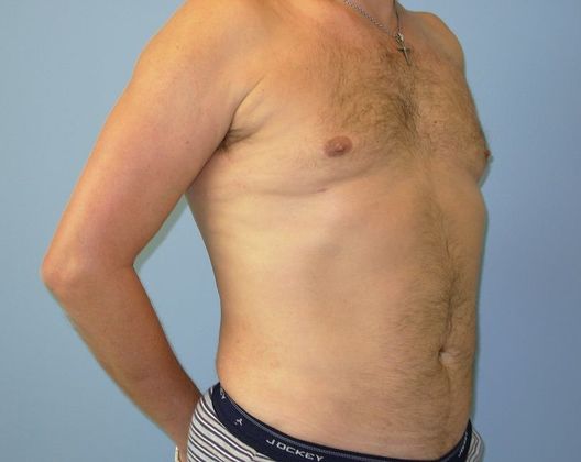 Male Body Contouring: Case 1 Male Liposuction Chest, Abdomen, Flanks - After