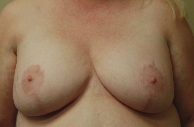 Massive Weight Loss : Case 27 - After