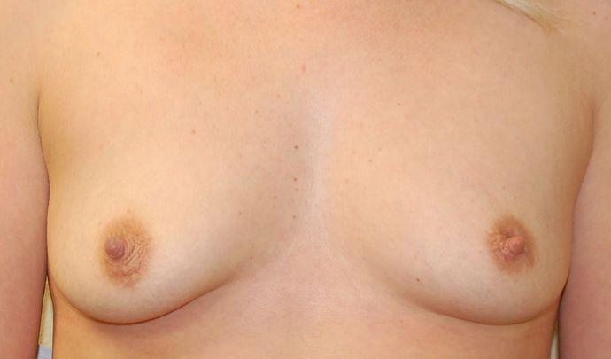 Breast Augmentation w/ Lift Case 165 - Before