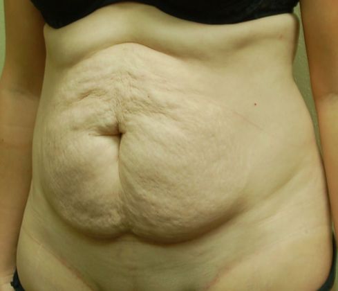 Tummy Tuck (Abdominoplasty): Case 82 - Before