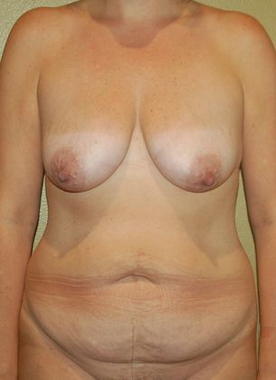 Mommy Makeover Case 70 - Before