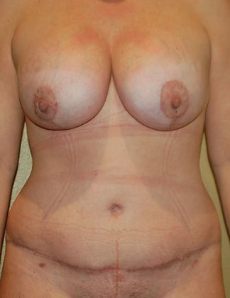 Mommy Makeover Case 70 - After