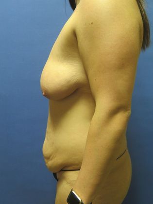 Mommy Makeover: Case 8 - Before