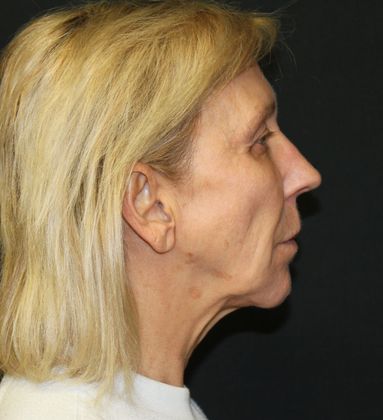 Facelift: Case 4 Facelift - Before