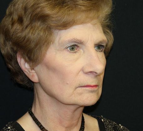 Facelift: Case 7 Facelift - After