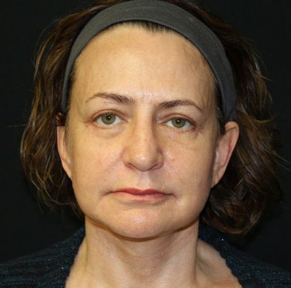 Facelift Case 9 Facelift - After