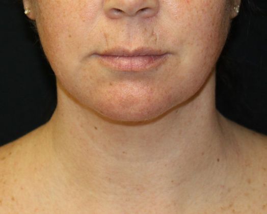 Neck Rejuvenation Case 6 Neck Liposuction - After