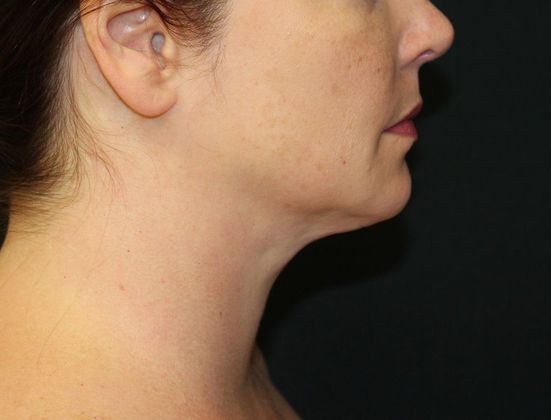 Neck Rejuvenation Case 7 Neck Liposuction  - After
