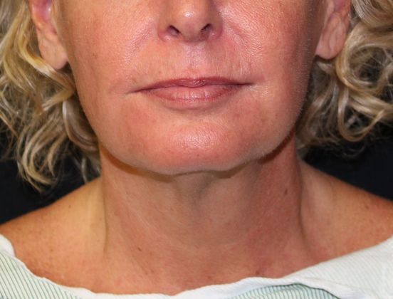 Neck Rejuvenation: Case 9 Neck Liposuction - Before