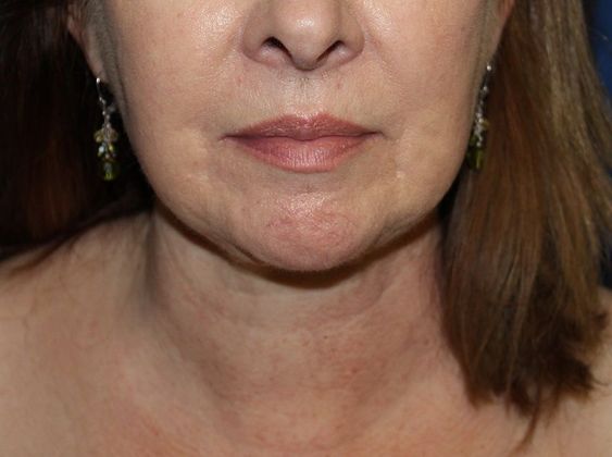 Neck Rejuvenation Case 1 Neck Liposuction - After