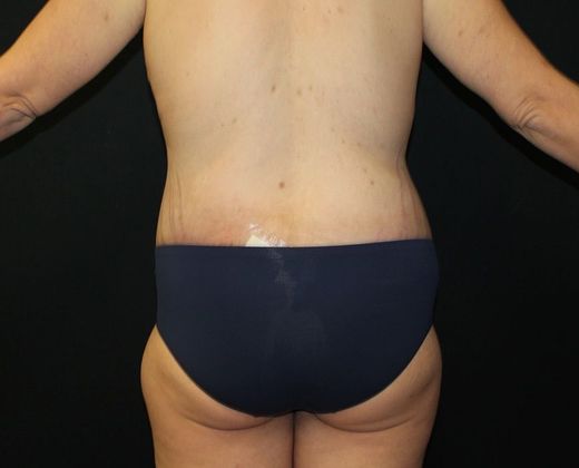 Lower Body Lift: Case 4 Lower Body Lift with Mastopexy - After