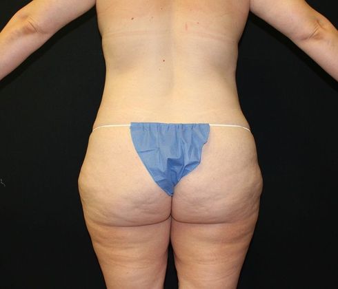 Mommy Makeover: Case 23 Mommy Makeover - Before