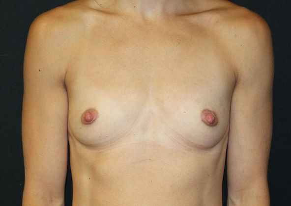 Breast Augmentation: Case 24 Breast Augmentation Frisco 390cc - Before