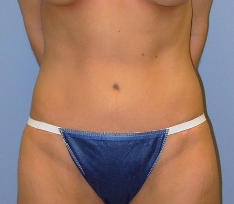 Abdominoplasty Case 1 Abdominoplasty - After