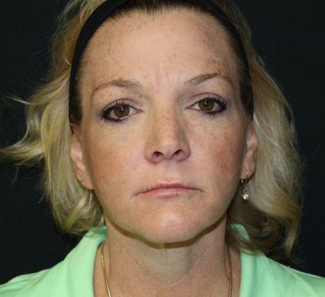 Facelift Case 6 Facelift - After