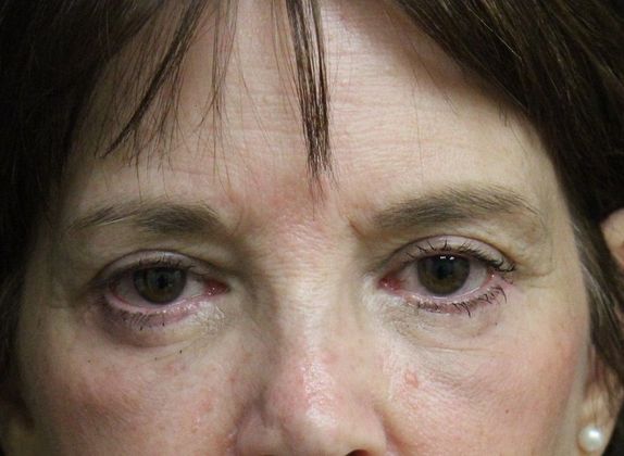 Eyelid Lift Case 9 Upper and Lower Eyelid Lift - After