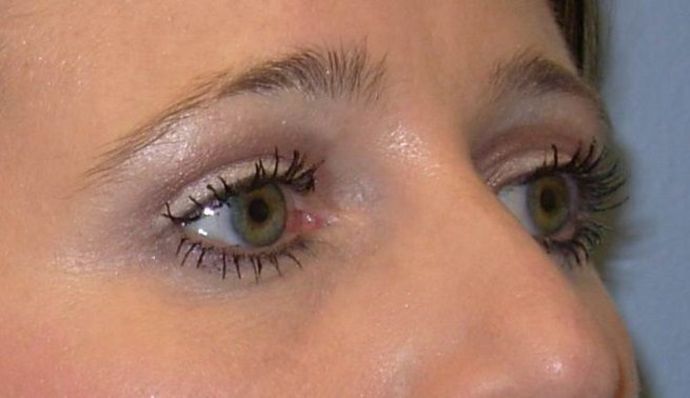 Eyelid Lift Case 2 Upper and Lower Eyelid Lift - After