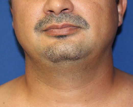 Neck Rejuvenation Case 4 Neck Liposuction - Before