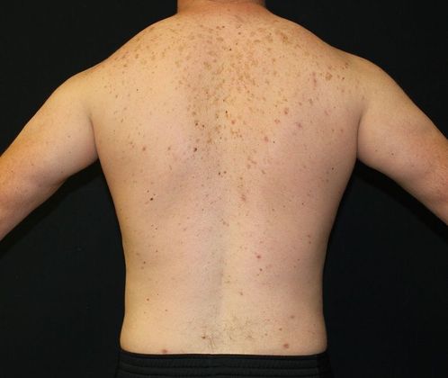 Male Body Contouring: Case 7 Male Liposuction Chest, Abdomen, Flanks - After