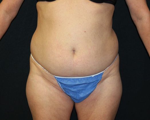 Liposuction Case 13 Liposuction Abdomen, Flanks, Thighs - Before