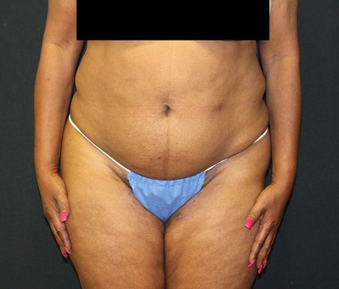 Liposuction of Flanks Before and After 3804