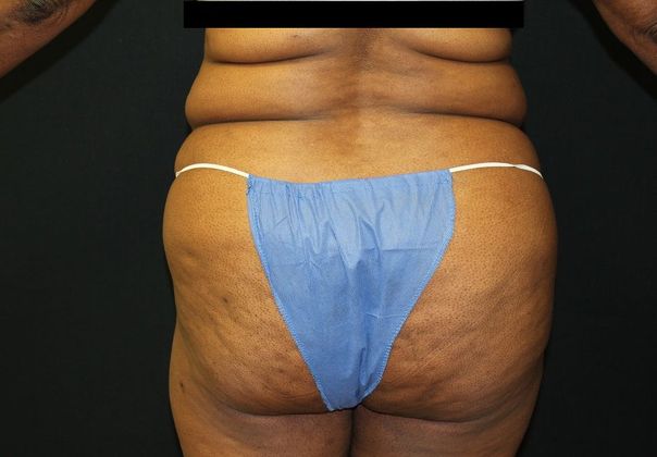 Flanks Liposuction  Before and After Photos - Palm Clinic