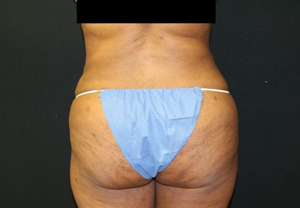 Liposuction - Abdomen / Flanks Before and After Pictures Case 14, Coeur  d'Alene, ID