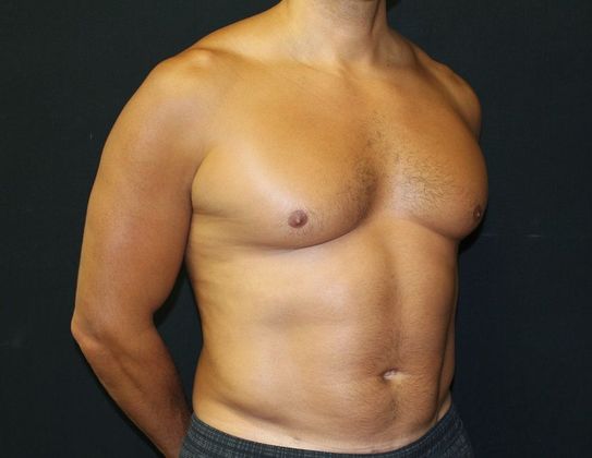 Male Body Contouring: Case 8 Male Liposuction Abdomen, Flanks - After