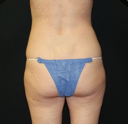 Liposuction: Case 20 Liposuction Abdomen, Flanks - Before