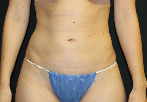 Liposuction: Case 18 Liposuction Abdomen, Flanks - After