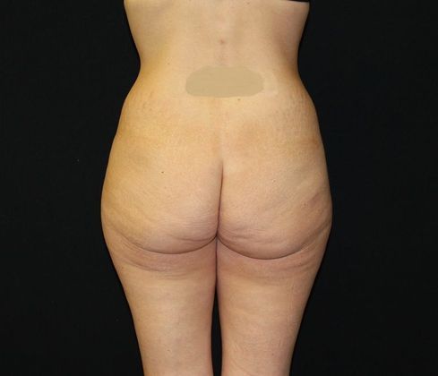 Liposuction: Case 22 Liposuction, Brazilian Butt Lift - Before