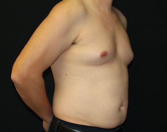 Patient 8284, Flank-Lower Back Liposuction, Male Liposuction Gallery