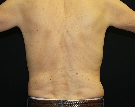 Male Body Contouring: Case 11 Male Liposuction Abdomen, Flanks - After