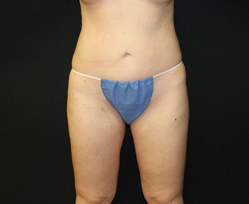 Liposuction Case 26 Liposuction Abdomen, Flanks, Back and Thighs - After