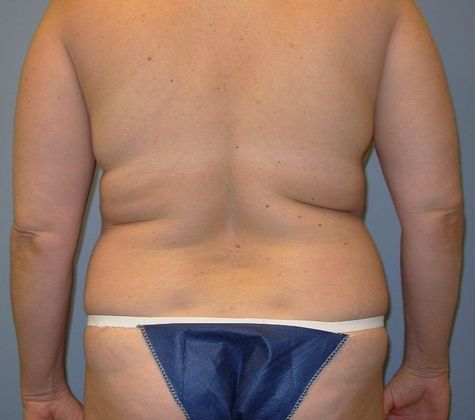 Liposuction: Case 8 Liposuction Flanks, Back - Before