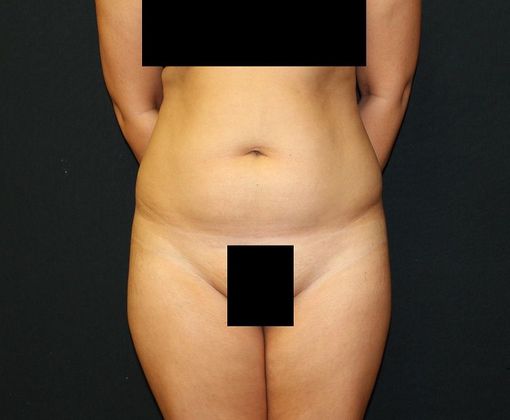 Liposuction: Case 28 Liposuction of Flanks, Back, Outer Thighs, Brazilian Butt Lift and Abdominoplasty - Before