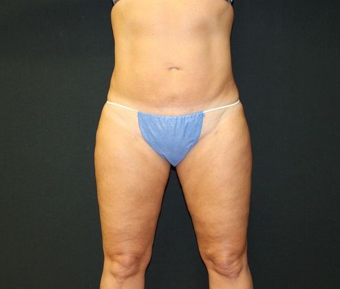 Upper and Lower Abdomen and Flank Liposuction, Inner and Outer Thigh  Liposuction with Fat Transfer to Buttocks - Terrell Clinic