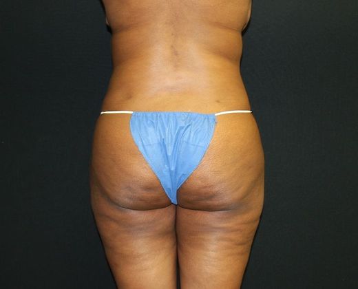 Abdominoplasty: Case 23 Abdominoplasty - After