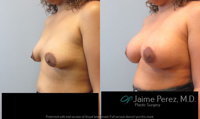 Breast Augmentation: Breast Augmentation 525cc.