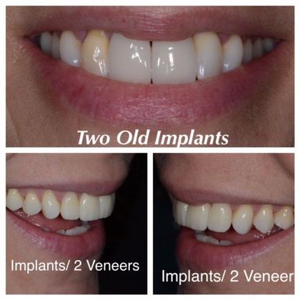 Smile Makeover Case 4: Doylestown - After