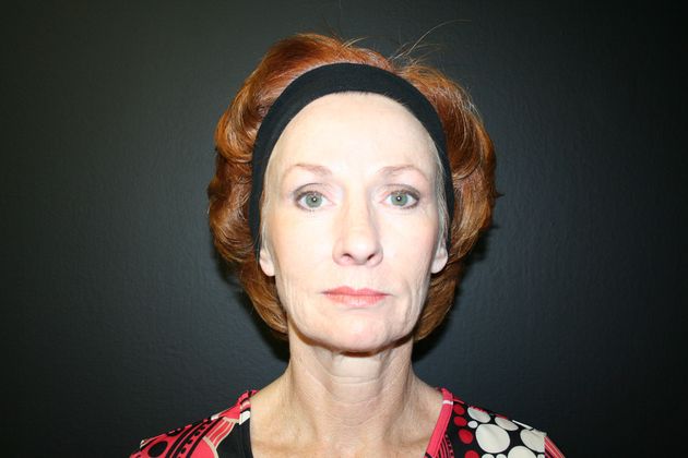 Facelift Case 1 - Before