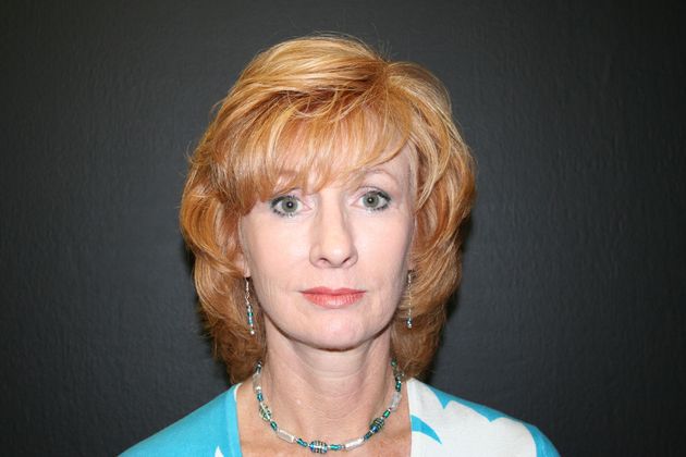 Facelift Case 1 - After